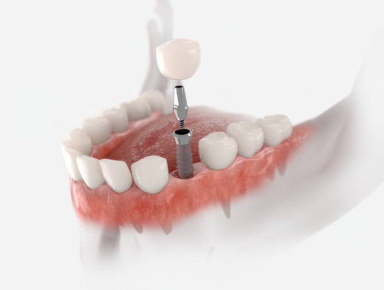 Benefits of Dental Implants