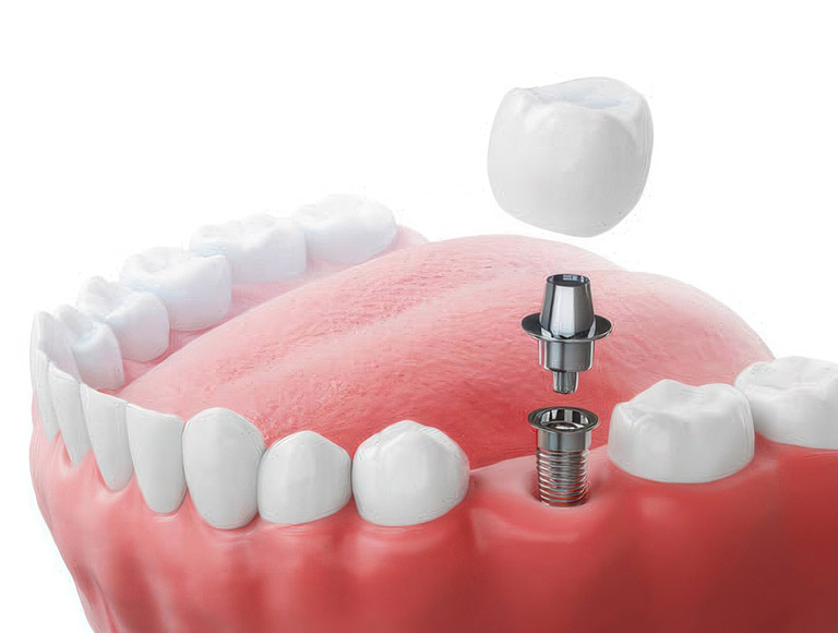 Are Dental Implants Right for You