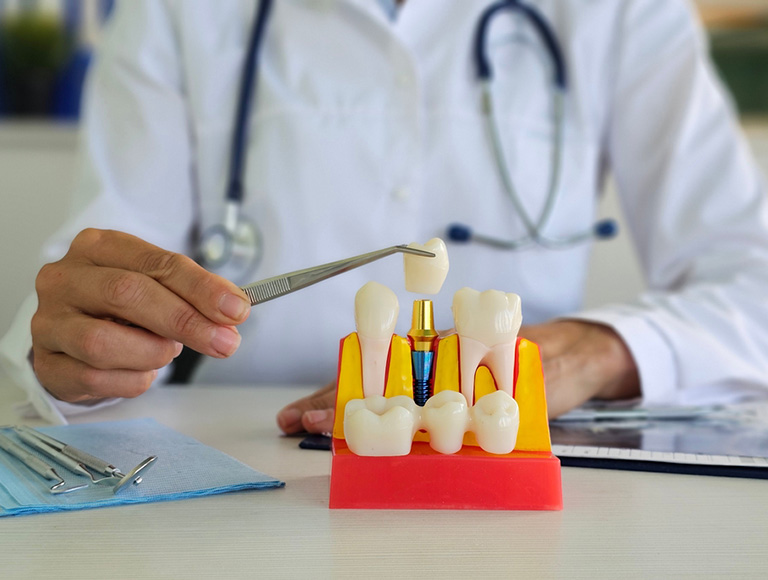 Benefits of Dental Implants