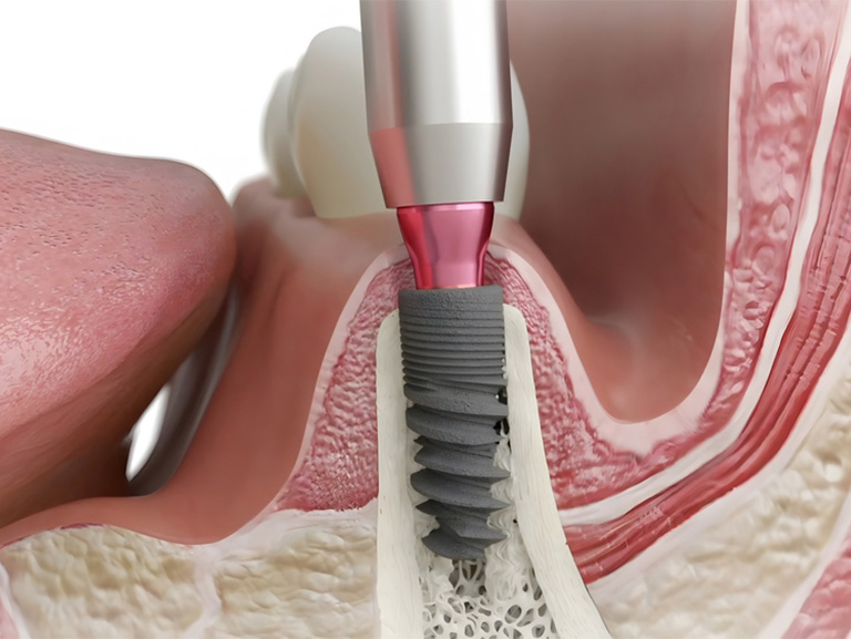 Are Dental Implants Right for You?