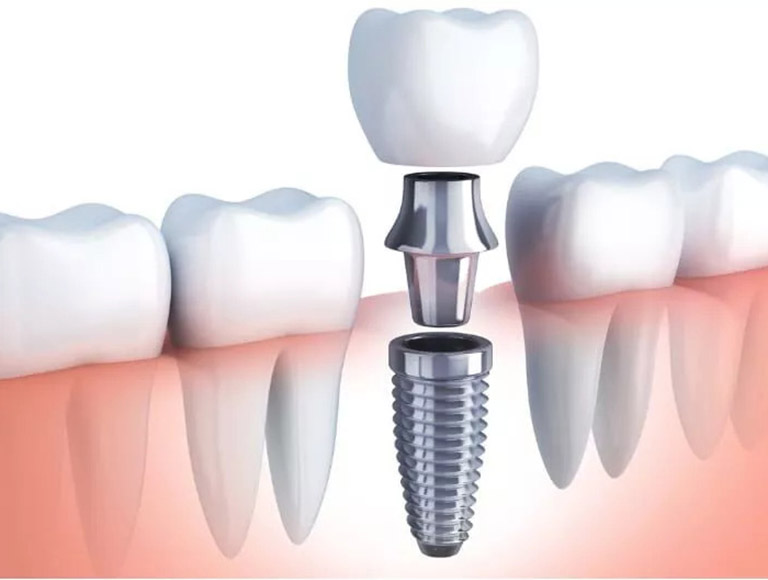 Our Dental Implant Process