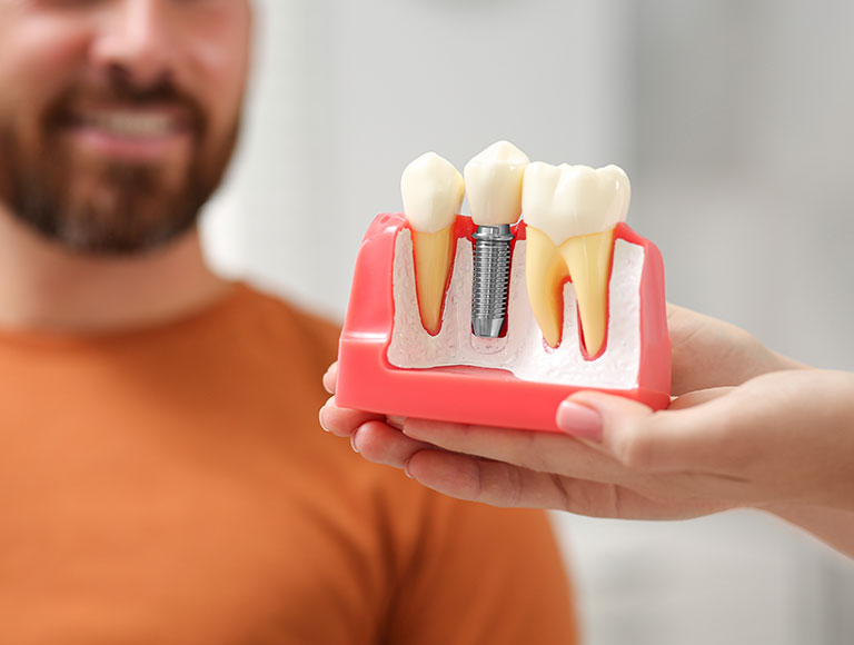 What Are Dental Implants?